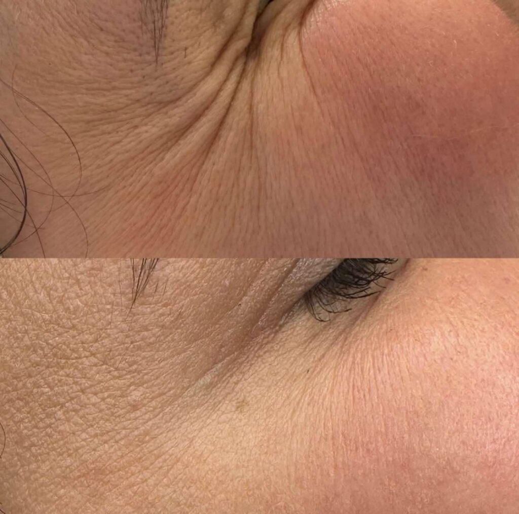 wygładzenie zmarszczek 3