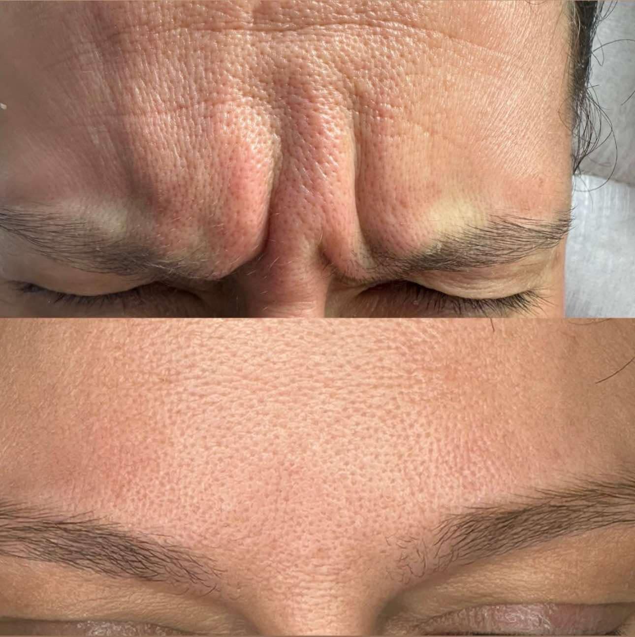 wygładzenie zmarszczek 2